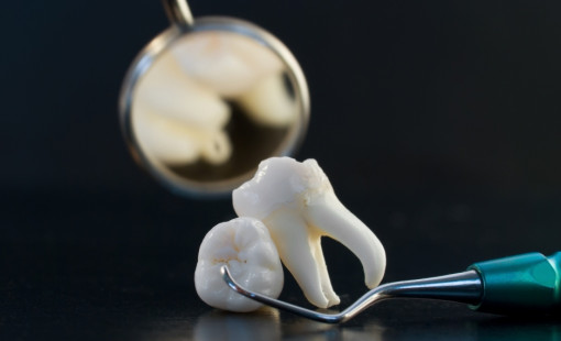 Удаление зуба без боли