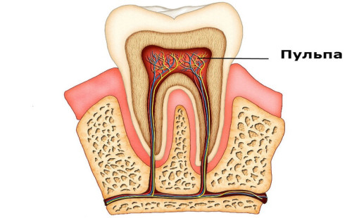 Лечение пульпита